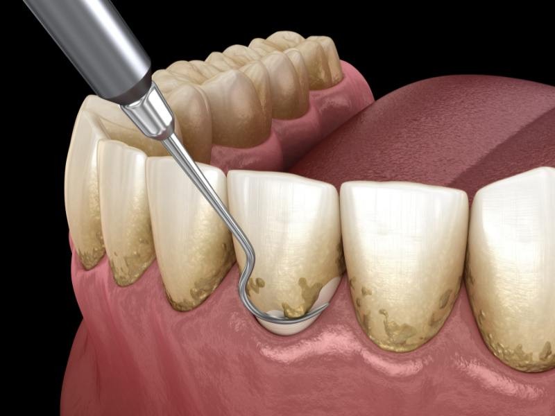 Raspagem periodontal